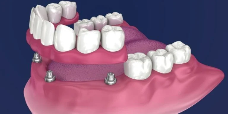 All-on-4 Dental Implants Procedure