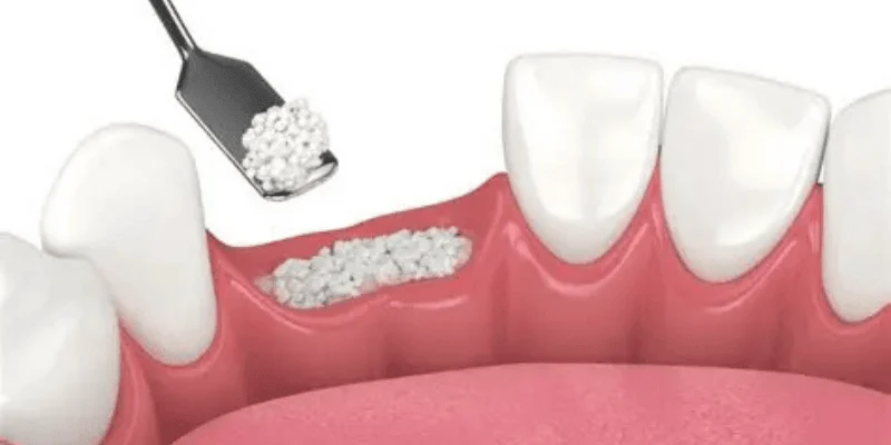 _Bone Grafting for Dental Implants
