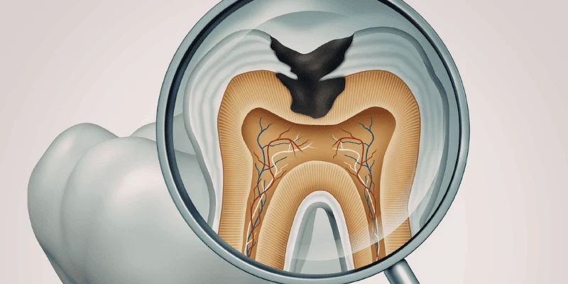 Illustration of decay inside a tooth under a magnifying glass