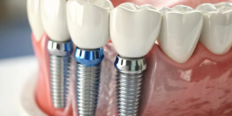 Dental Implants for Natural Bite