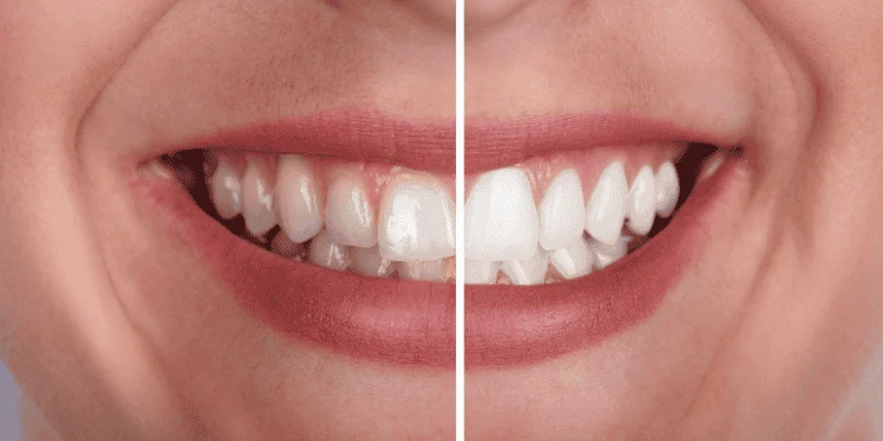 Effectiveness and Longevity of Whitening Results