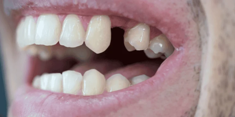 Missing Teeth Jawbone Loss