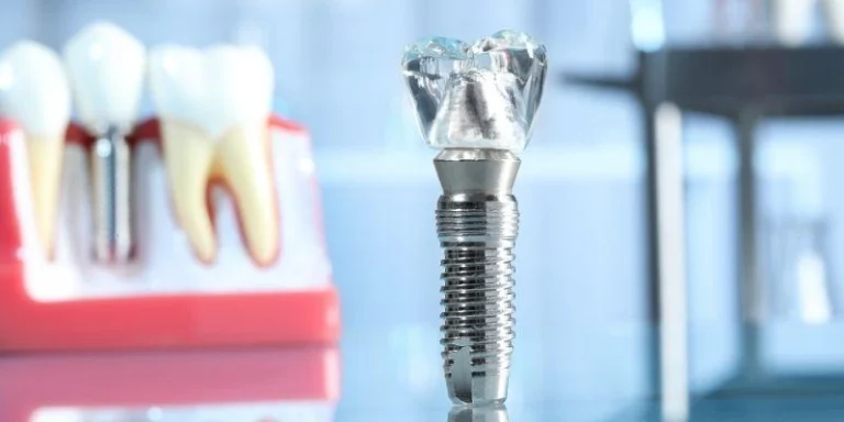 Risks of Dental Implants