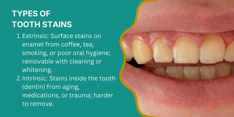 Types of tooth stains: extrinsic and intrinsic