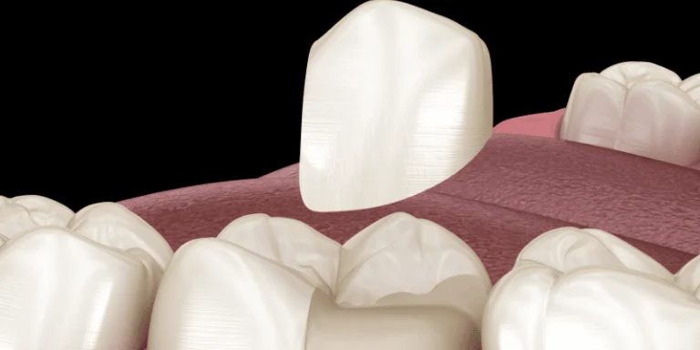 large filling vs inlay onlay