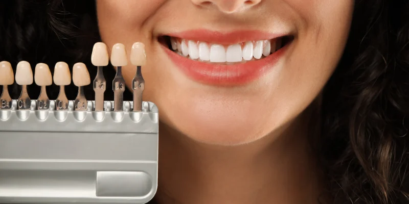when and how to replace porcelain veneers